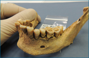 Late Iron Age/Roman woman showing large dental calculus deposit, from Cambridge area, UK. Photo: Alan Cooper