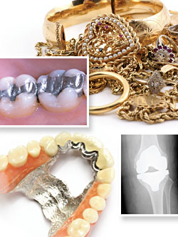 Metal allergies to dental implants.