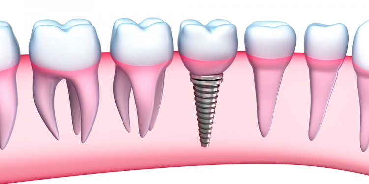 What are Dental implants?