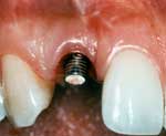 Photo of extension attached to implant