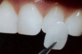 Porcelain Veneers