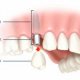 Are dental implants covered by dental insurance