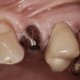 Are Dental Implants dangerous