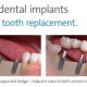 Best Dental Implant Specialist