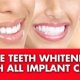 Cosmetic Dental Implants