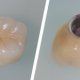 Crown for Dental Implant