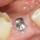 Dental Implant Healing Abutments