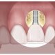 Dental Implant movement