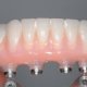 Dental Implant stent