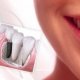 Dental Implantation cost