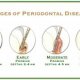 Dental Implants and Periodontal Disease