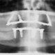 Dental Implants complaints