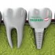 Dental Implants Options