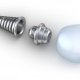Dental Implants parts
