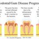 Dental Implants Periodontal Disease