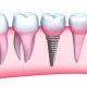 Dental Implants Procedure