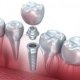 Dental Implants Procedures
