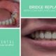 Dental Implants upper jaw