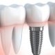 Does any insurance cover dental implants