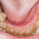 Does health insurance cover dental implants