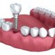 Getting a Dental implant