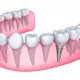 Kinds of Dental Implants
