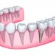 Kinds of Dental Implants
