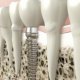 TADs Dental Implant