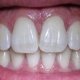 Tooth Decay and Heart disease