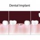 Tooth Implants covered by insurance