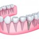 Types of tooth Replacement