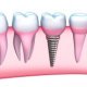 What are the risks of Dental implants?