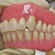 What is Dentures implants?