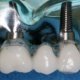 What kind of Dentist does Dental implants?