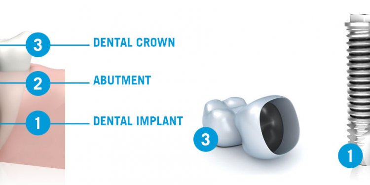 Dental Implant components