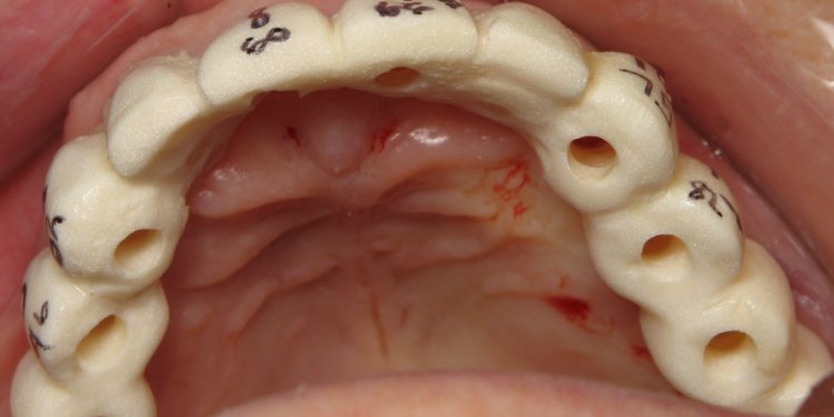 Surgical stent for Dental Implants