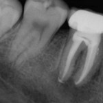 root canal image