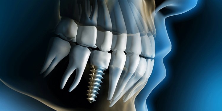Dentistry that do Dental Implants
