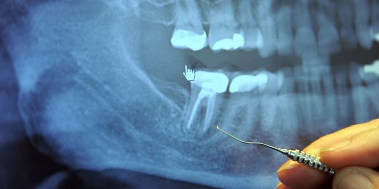 Can titanium Implants cause cancer?