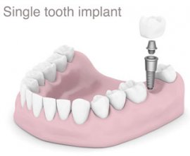 single tooth implant