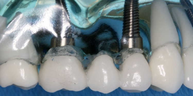 What kind of Dentist does Dental implants?