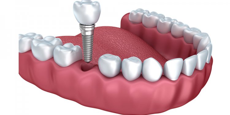 Getting a Dental implant