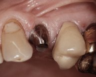 Are Dental Implants dangerous