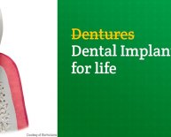 Benefits of Dental Implants