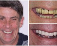 Best Dental Implants