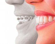 Cosmetic Dentistry, Dental implants