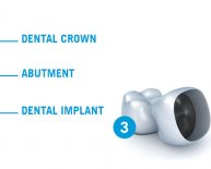 Dental Implant components