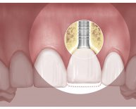 Dental Implant movement