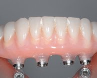 Dental Implant stent