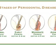 Dental Implants and Periodontal Disease